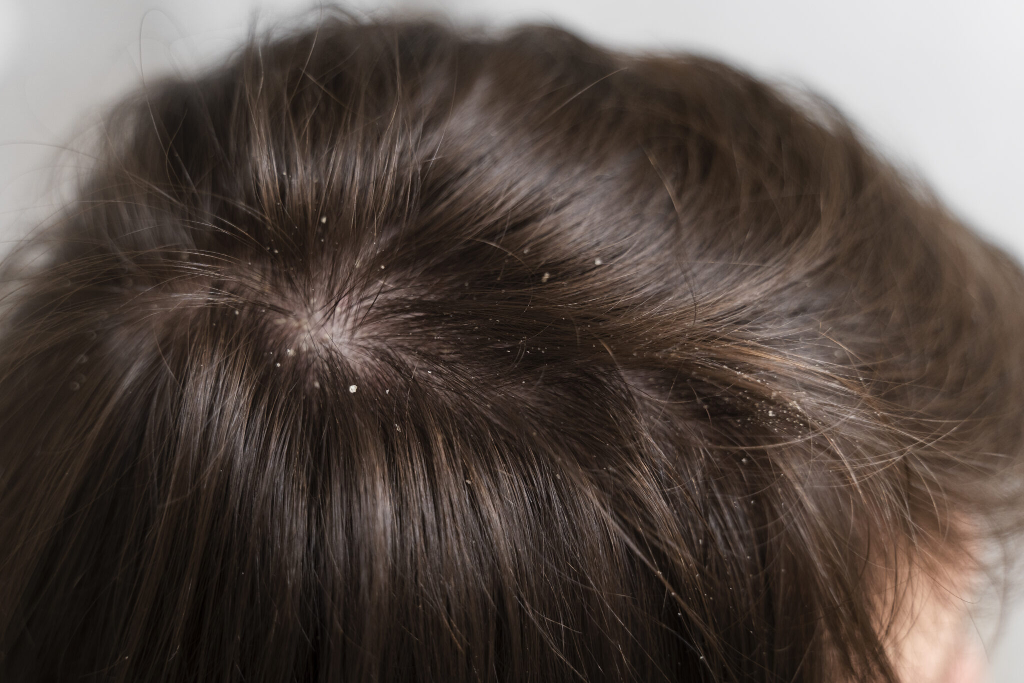 Everything You Need To Know about Scalp Irritation